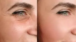 Polinucleótidos: la nueva elegancia del cuidado de la piel a partir de los 30